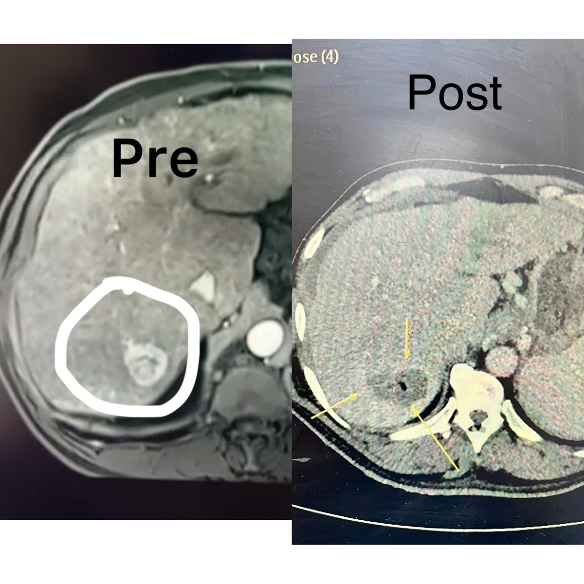 Pulkit Rangarh (@pulkitrangarh) on Twitter photo #interventionaloncology 5 - Solitary HCC - #microwave ablation - complete necrosis. Tumor free treatment in 5 minutes - most minimal invasive way of curing the HCC. <a href="/AIMSFaridabad/">Asian Hospital</a> <a href="/ISVIRIndia/">ISVIR India</a> #interventionalradiology #interventionaloncology 5 - Solitary HCC - #microwave ablation - complete necrosis. Tumor free treatment in 5 minutes - most minimal invasive way of curing the HCC. <a href="/AIMSFaridabad/">Asian Hospital</a> <a href="/ISVIRIndia/">ISVIR India</a> #interventionalradiology