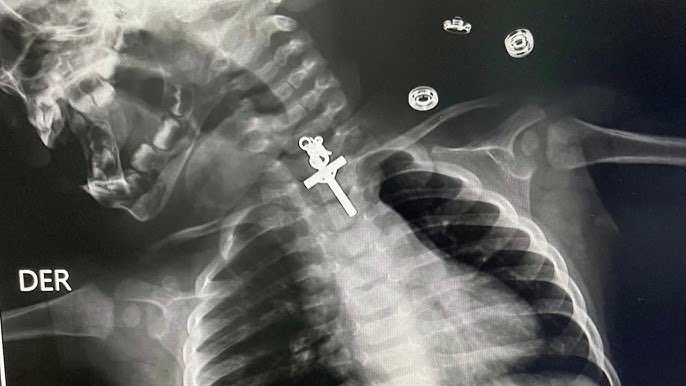 X-ray image show a crucifix lodged in a 10-month-old child's esophagus before it was successfully removed by medical staff in 2023.