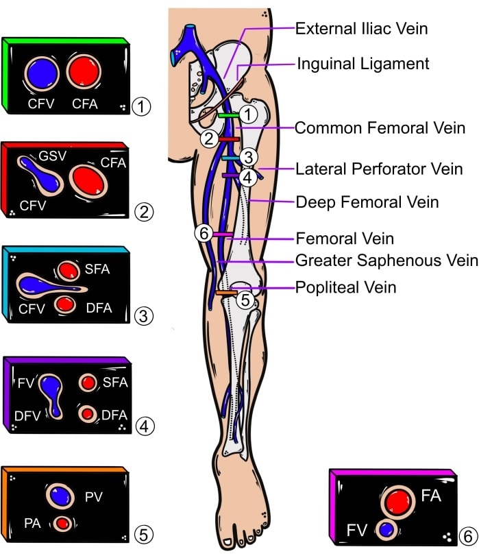 🔴Point-Of-Care Ultrasound Screening for Proximal Lower Extremity DVT⤵️ 

 🔹Lower limb venous #anatomy for #DVT #POCUS 

 🔹jove.com/t/64601/point-…  
 #Cardiology #FOAMed #MedEd #medstudent #paramedic #Cardiology #CardioEd #medtwitter #meded