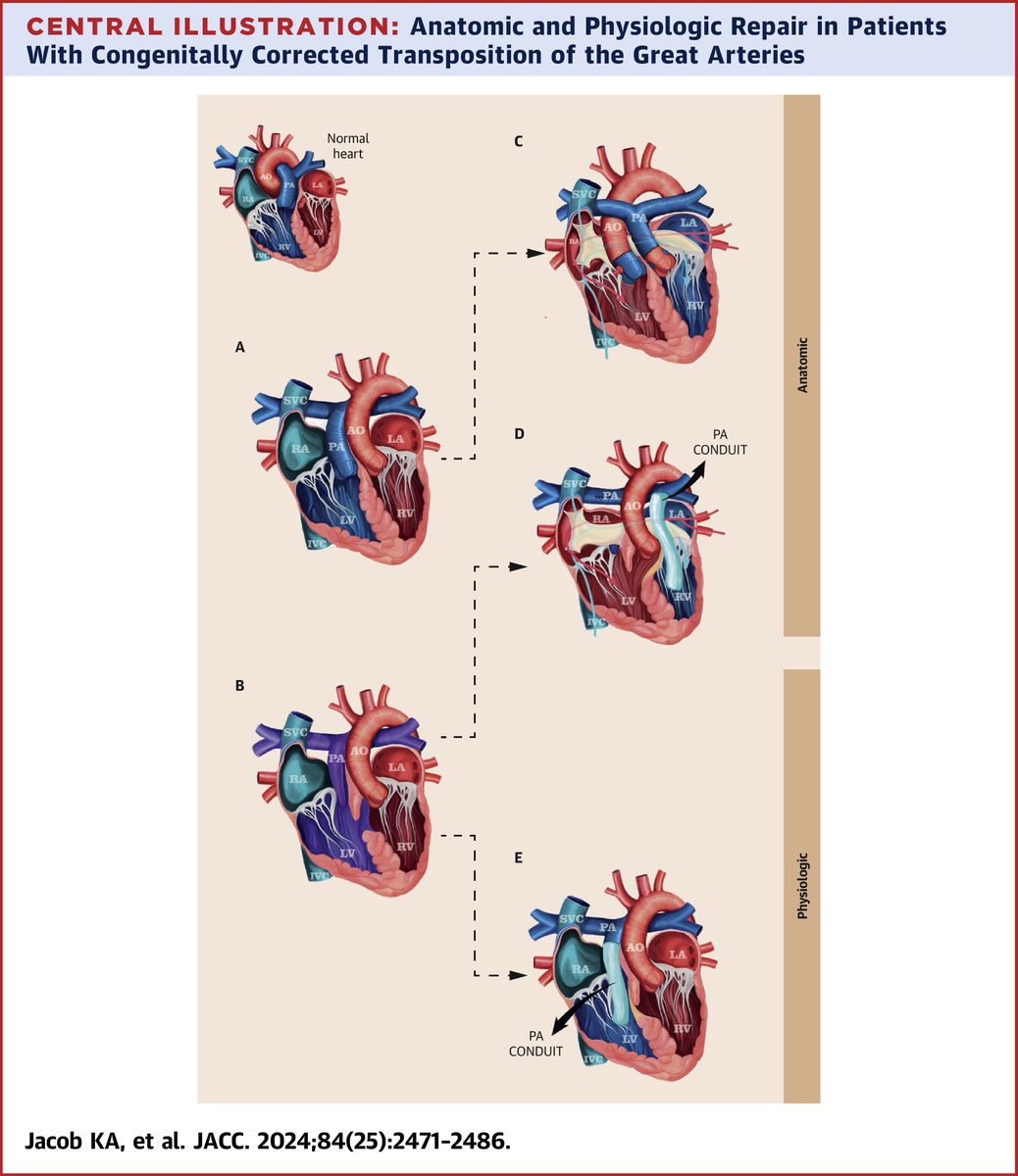 JACCJournals's tweet photo. Anatomic repair of congenitally corrected transposition results in better overall and reintervention-free survival.

Should it be the standard? 🤔  

#JACC 📎: https://t.co/7ELqeLKu15 https://t.co/x1dTz864I9