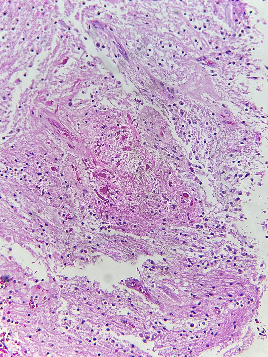 Immanuel_Paul30's tweet photo. Posterior fossa SOL
15/F
Brightly eosinophilic birefringrent inclusions in short chains/corkscrew shaped forms (Rosenthal fibers) and granular eosinophilic bodies galore !
#cytopath #neuropath #PathTwitter #surgicalpath #oncopath #imanpath #squashcytology https://t.co/tE6ukugCWY