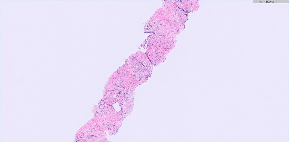 slusagar's tweet image. an early #GUpath #IDpath holiday🎁for everyone!

prostate bx:
granulomatous prostatitis secondary to Coccidioides

(patient had hx)