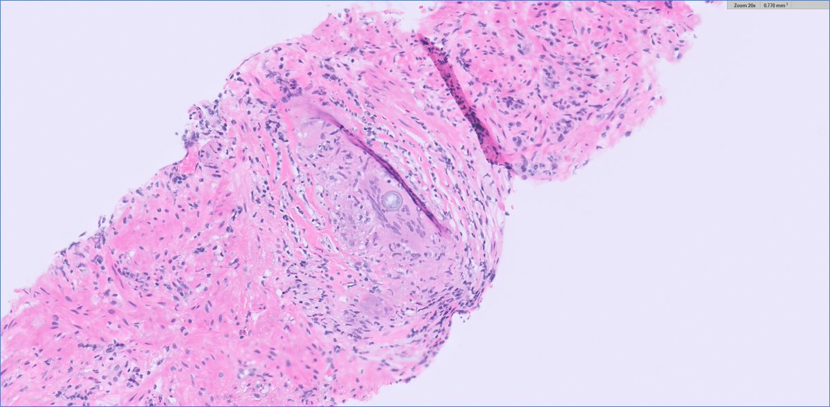 slusagar's tweet image. an early #GUpath #IDpath holiday🎁for everyone!

prostate bx:
granulomatous prostatitis secondary to Coccidioides

(patient had hx)