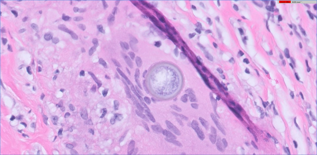 slusagar's tweet image. an early #GUpath #IDpath holiday🎁for everyone!

prostate bx:
granulomatous prostatitis secondary to Coccidioides

(patient had hx)