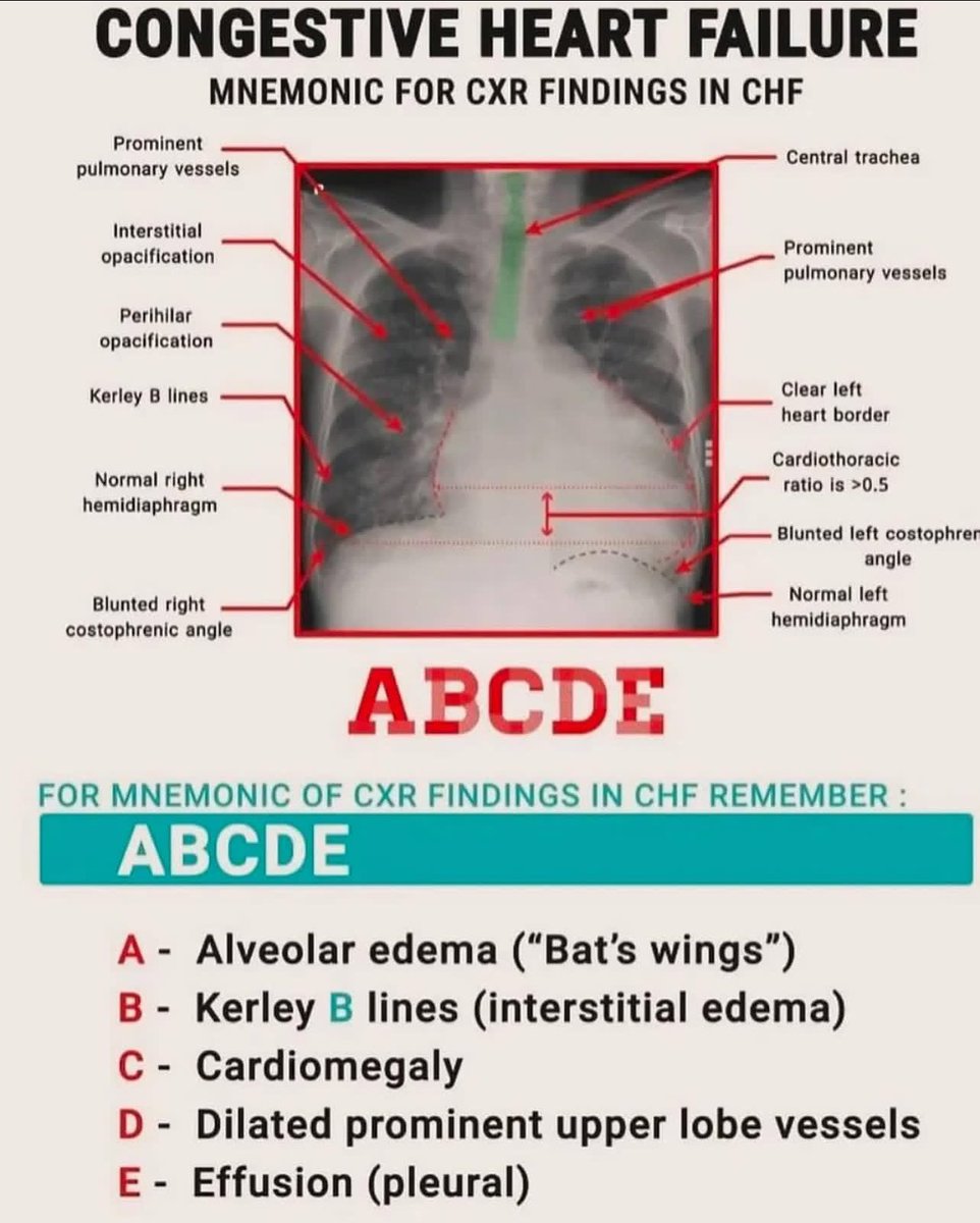 DrMedica_13's tweet photo. Congestive Heart Failure 🫀

☄️☄️☄️
#MedEd #MedX #CardioMed https://t.co/PEwYpFdh1n