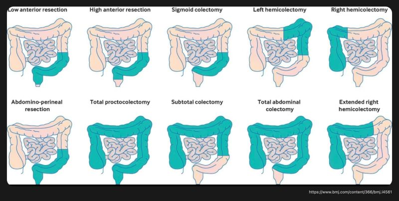 Types of Colectomies:

↓
- Low anterior resection

- High anterior resection

- Sigmoid colectomy

- Left hemicolectomy

- Right hemicolectomy

- Abdominal-perineal resection

- Total proctocolectomy

- Subtotal colectomy

- Total abdominal colectomy