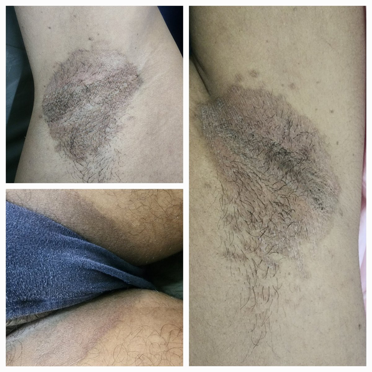 ArunInamadar's tweet photo. Spotter : .... clue bacterial infection https://t.co/cWGJ1sJhoI