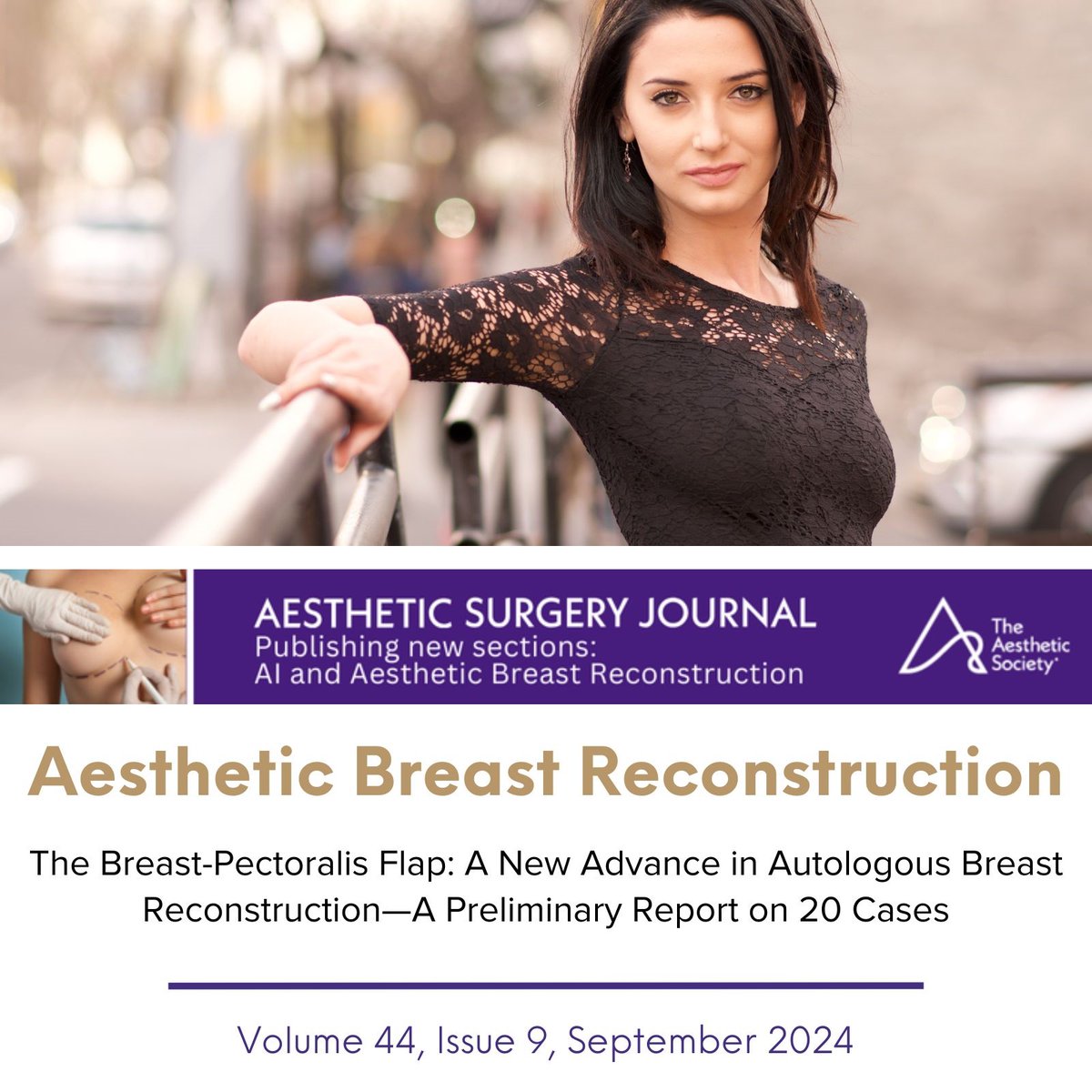 Aesthetic Surgery Journal/ASJ Open Forum (@asjrnl) on Twitter photo This study aimed to present a new breast reconstruction technique that uses a combination of the breast-pectoralis flap and the abdominal advancement flap.
🔗Read, cite, share the paper: doi.org/10.1093/asj/sj…
@phaedracress <a href="/drkenkel/">Jeffrey Kenkel, MD</a> <a href="/PatMcGuireMD/">Patricia Ann McGuire</a> <a href="/NahaiDr/">Dr Nahai</a> <a href="/MarkAlbertMD/">Mark Albert</a> This study aimed to present a new breast reconstruction technique that uses a combination of the breast-pectoralis flap and the abdominal advancement flap.
🔗Read, cite, share the paper: doi.org/10.1093/asj/sj…
@phaedracress <a href="/drkenkel/">Jeffrey Kenkel, MD</a> <a href="/PatMcGuireMD/">Patricia Ann McGuire</a> <a href="/NahaiDr/">Dr Nahai</a> <a href="/MarkAlbertMD/">Mark Albert</a>