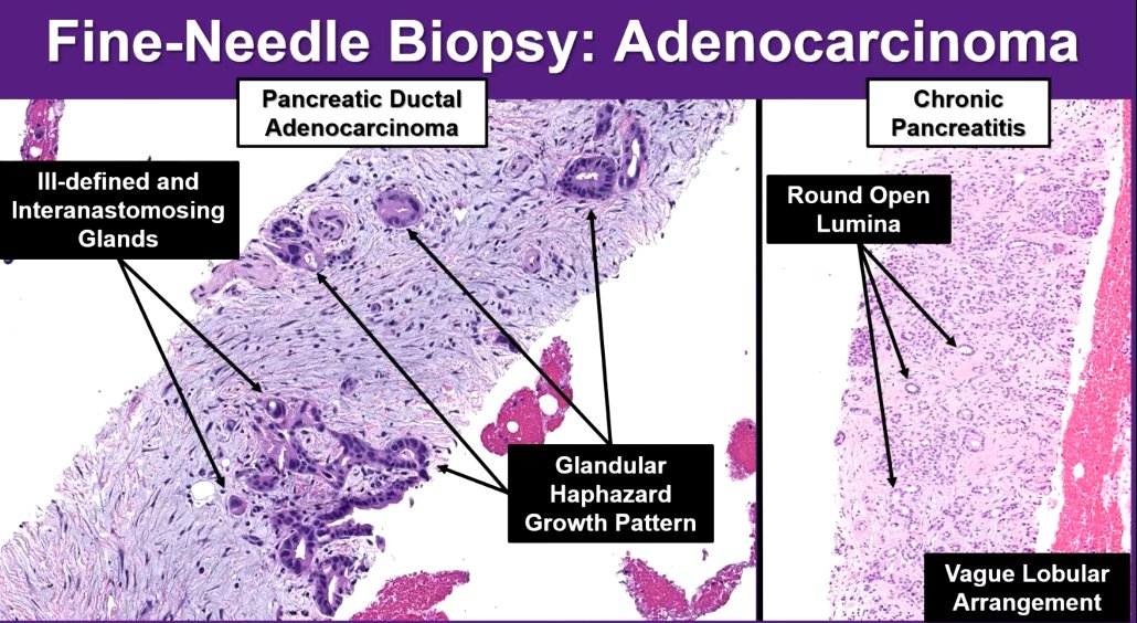 Janiranavarro's tweet image. Pancreas -core needle biopsy
Chronic pancreatitis (right)
-Round open lumina
-Vague lobular arrangement

Pancreatic ductal adenocarcinoma (left)
-Ill-defined glands
-Glandular haphazard growth pattern

Dr. Singhi #CAP24  #pathology #pathologists #pathresidents #pathfellows