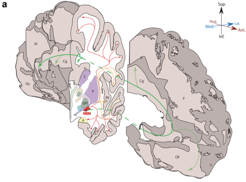movedisorder's tweet photo. MRI is a cost-effective tool for studying the cholinergic system in PD dementia. Reduced volume of the nucleus basalis of Meynert (Ch4) in cognitively impaired PD patients may serve as a prognostic marker for future cognitive decline. https://t.co/MwKjsm3q9p https://t.co/rv9Zyr5OZR