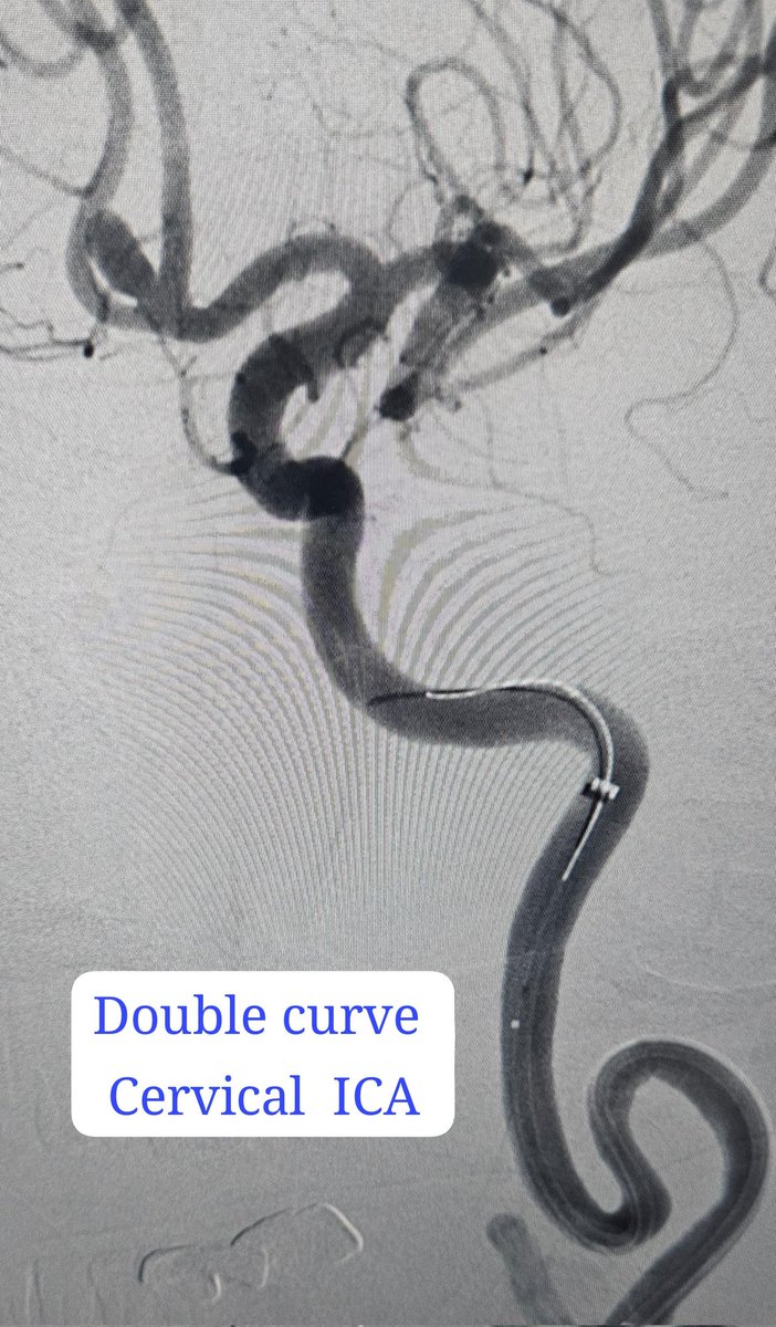 SharathKumarGG7's tweet image. Grade 3 SAH by ruptured Acom aneurysm treated with simple coiling! Time to finish from groin puncture is &amp;lt;45 min. Thanks to modern medical technology enabling the operator to get out of the risky zone 😬  very quickly and also efficiently 😃  #Coiling #Aneurysm #SAH #AcomAneurysm