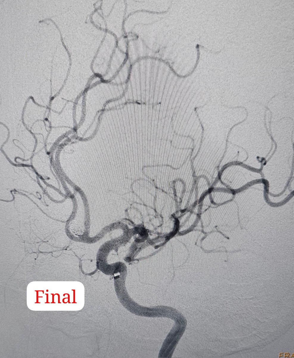 SharathKumarGG7's tweet image. Grade 3 SAH by ruptured Acom aneurysm treated with simple coiling! Time to finish from groin puncture is &amp;lt;45 min. Thanks to modern medical technology enabling the operator to get out of the risky zone 😬  very quickly and also efficiently 😃  #Coiling #Aneurysm #SAH #AcomAneurysm