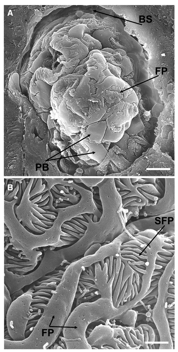 REVIEW: Mechanistic Insights Into Redox Damage of the Podocyte in Hypertension

ahajrnls.org/41P71dJ