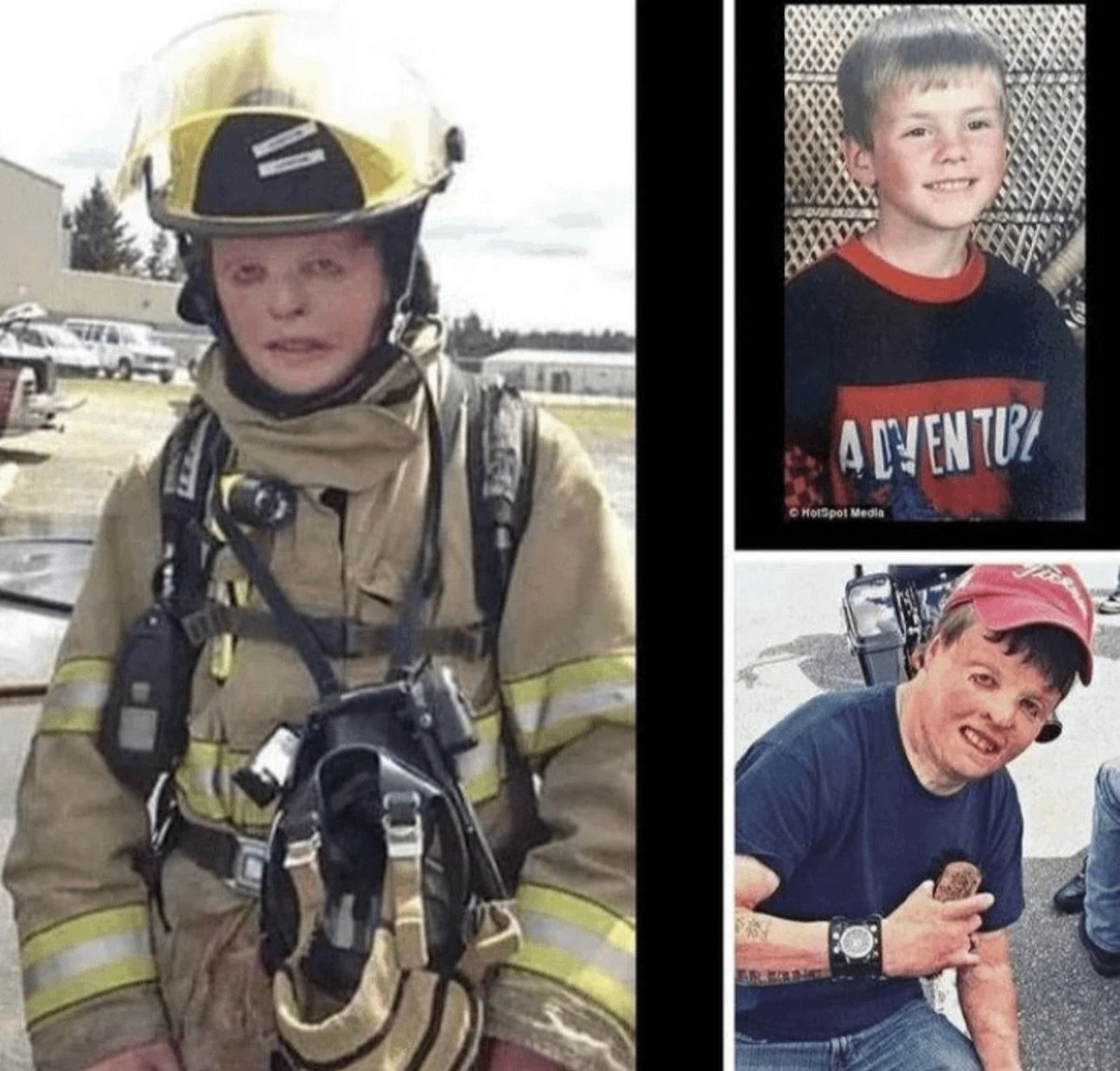 Despite suffering severe burns as a child, this man went on to become a firefighter