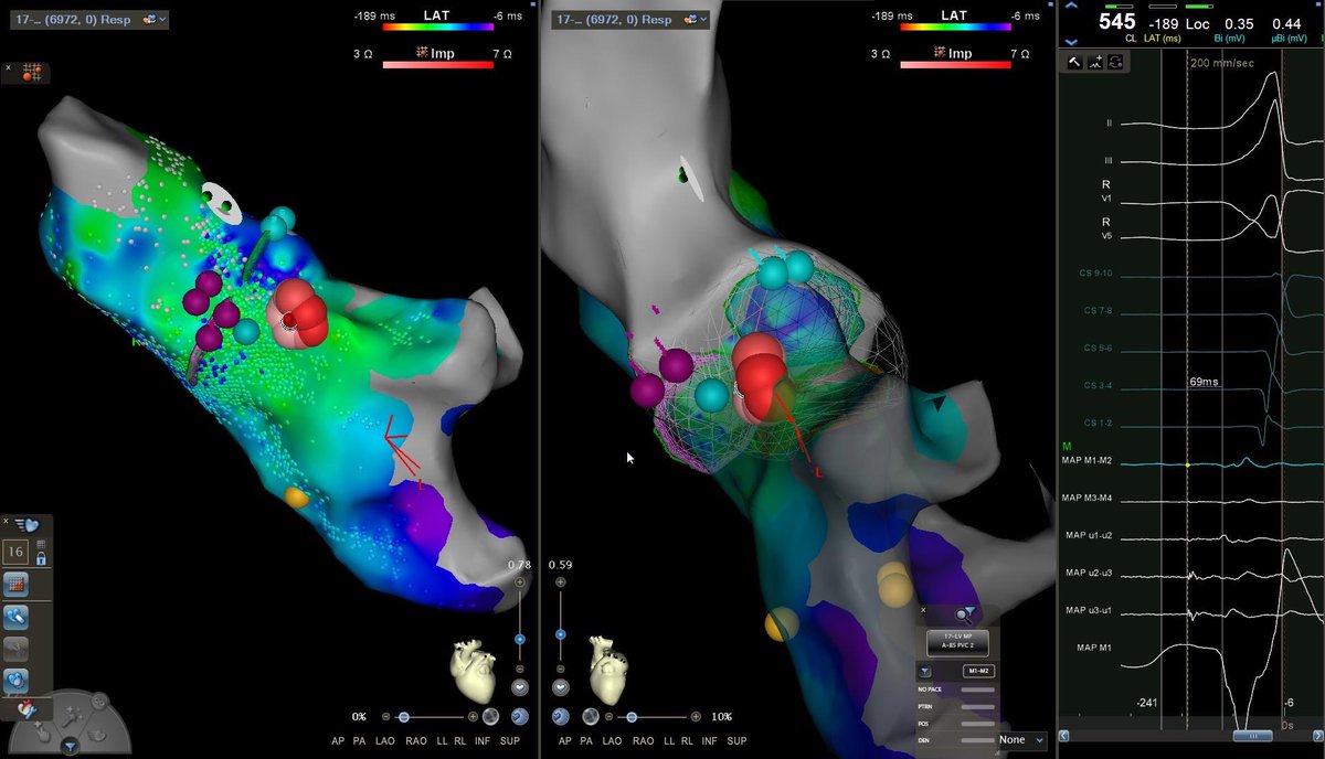 Pattara Rattanawong, MD, FACC, FHRS (@pat_nawong) on Twitter photo No early signals on Optrel or standard catheters, but the Qdot micro-electrode nailed it—69 msec clear as day. One burn, PVC eliminated. <a href="/TFern5334/">Travis Fernandez</a> #PVC #Qdot #Epeeps No early signals on Optrel or standard catheters, but the Qdot micro-electrode nailed it—69 msec clear as day. One burn, PVC eliminated. <a href="/TFern5334/">Travis Fernandez</a> #PVC #Qdot #Epeeps