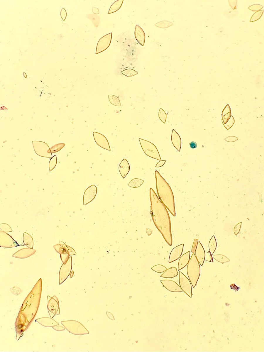 Voided urine containing what type of crystal? Answer: buff.ly/3lqUIBg  #PathTwitter #CytoPath #MedTwitter