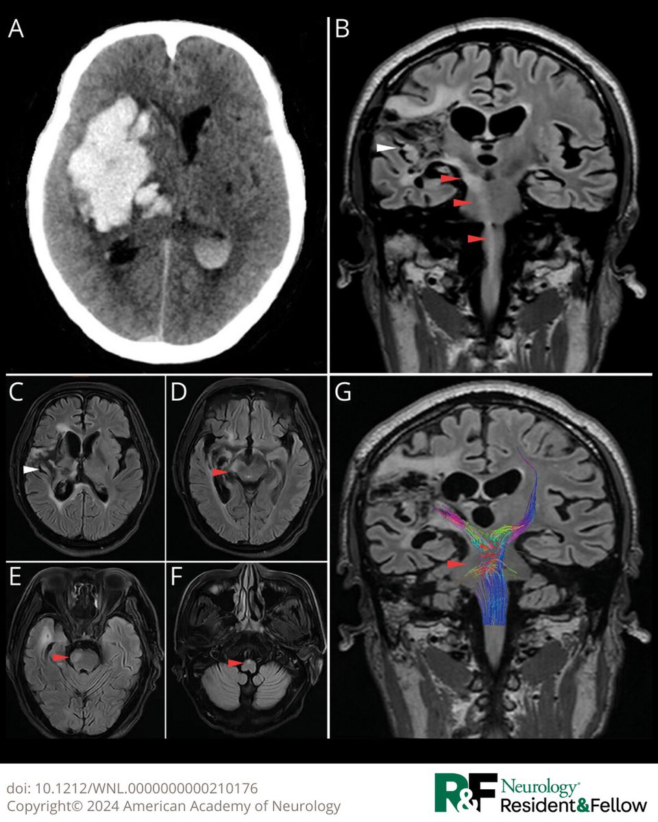 Wallerian degeneration is a pathologic change of distal nerve degeneration resulting from neuronal damage. The breakdown of myelin lipid and resultant gliosis could lead to increased hydrophilicity and hyperintensity on FLAIR. Learn more: bit.ly/4ixGzv3

#NeurologyRF