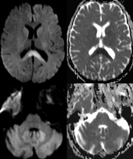 ⭐️ Classic case: 60 y/o F w/ PMH of cirrhosis presents w/ altered mental status and dysarthria. What is the most likely diagnosis?

#Neurology #Neurosurgery #MedEd #medicine #radres #futureradres #ENT #FOAMed