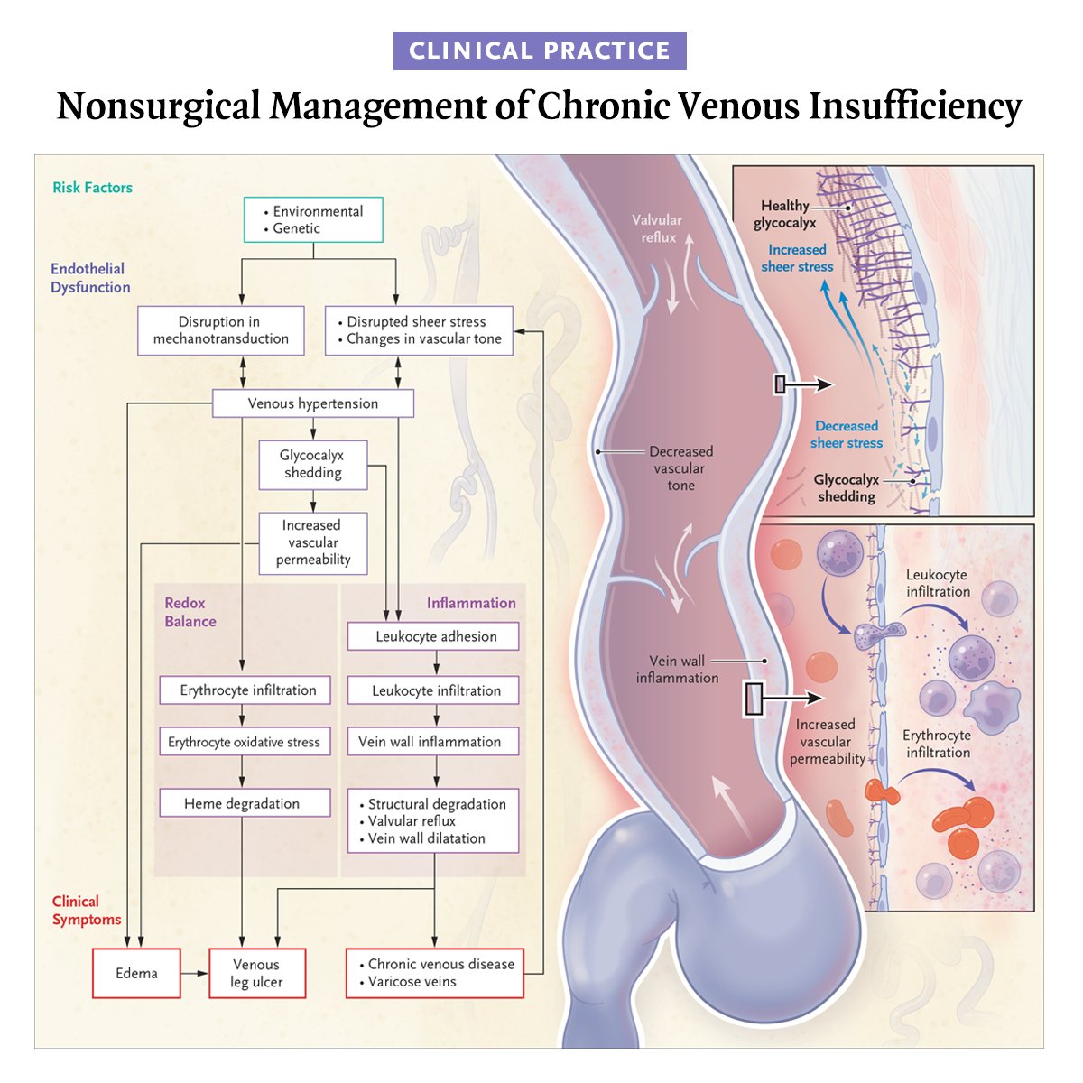 Chronic venous insufficiency is mainly due to venous hypertension, the cause of which can be structural or functional. Treatment is aimed at decreasing venous hypertension through conservative, nonprocedural management. Full Clinical Practice article: nej.md/41Zd5Av