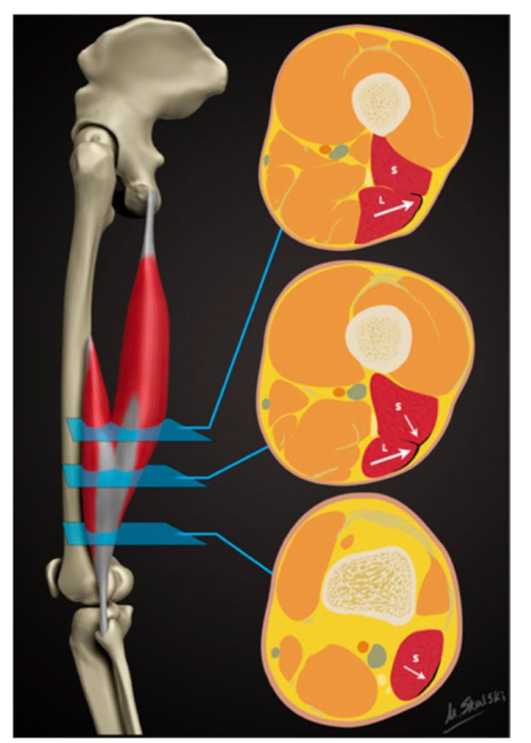 Ryan Timmins (@ryan_timmins) on Twitter photo 🚨Open Access 🚨"The Structure, Function, and Adaptation of Lower-Limb Aponeuroses: Implications for Myo-Aponeurotic Injury"
New from <a href="/HulmScott/">Scott Hulm</a>
rdcu.be/d4Khl 🚨Open Access 🚨"The Structure, Function, and Adaptation of Lower-Limb Aponeuroses: Implications for Myo-Aponeurotic Injury"
New from <a href="/HulmScott/">Scott Hulm</a>
rdcu.be/d4Khl