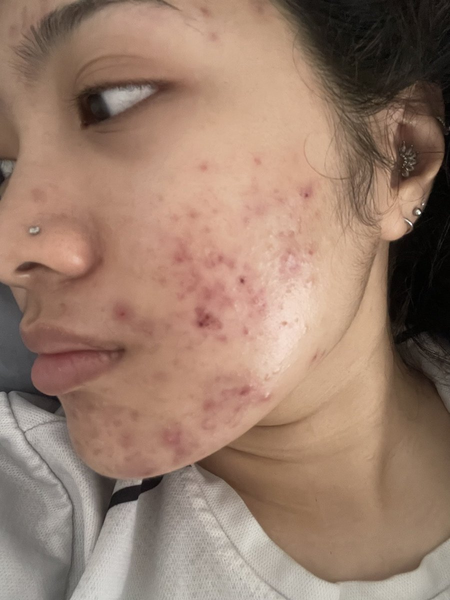yanaazmill's tweet photo. Dulu I pernah guna ubat jerawat Tidact, pastu purging teruk. I stop pakai 2 bulan, baru lah I cuba adapalene gel (differin) pula.

Now I'm on my 2nd tube, and kulit memang ada banyak improvement after that!! ^^

My skin in May vs in December https://t.co/yg8PTgJIes