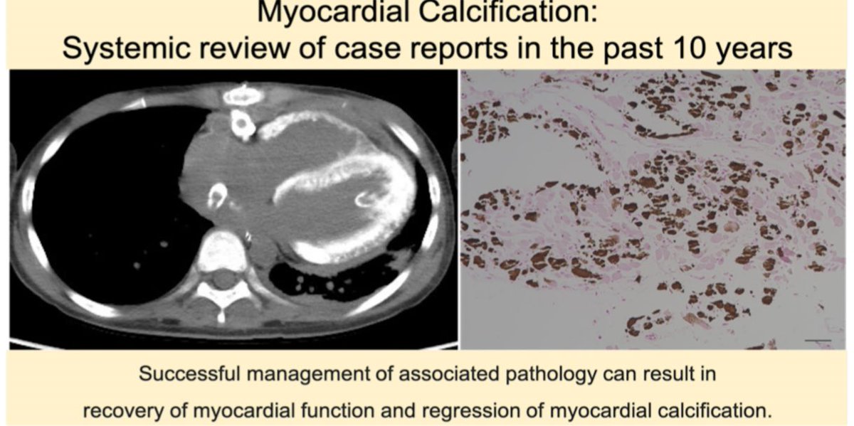 EHJ-IMP Editor-in-Chief (@ehjimpeic) on Twitter photo <a href="/ESC_Journals/">European Society of Cardiology Journals</a> <a href="/alessia_gimelli/">Alessia Gimelli</a> <a href="/EZancanaroMD/">Edoardo Zancanaro MD</a> <a href="/ShehabAnwer/">Shehab Anwer, MD</a> <a href="/EACVIPresident/">EACVI President</a> <a href="/HanCardiomd/">Henry Han</a> <a href="/Sarah_Moharem/">Sarah Moharem Elgamal, MBBCh, MSc, PhD👩🏻⚕️🫀</a> <a href="/echo_stepbystep/">Vladyslav Kavalerchyk 🇺🇦</a> <a href="/JGrapsa/">Julia Grapsa MD, PhD</a> <a href="/leylaelifsade/">LEYLA ELIF SADE</a> <a href="/DonalErwan/">Donal</a> <a href="/pabloplopez_/">Pablo Pérez López</a> <a href="/denisamuraru/">Denisa Muraru</a> <a href="/mmonaghan07/">Prof Monica Monaghan FESC PhD MBBCh BSc FRCP</a> <a href="/escardio/">European Society of Cardiology</a> <a href="/PeroneFrancesco/">Francesco Perone</a> <a href="/SilCastelletti/">Silvia Castelletti</a> <a href="/AnnaKateBarton/">Anna Kate Barton</a> <a href="/saramoscatelli7/">Sara Moscatelli</a> <a href="/iamritu/">Ritu Thamman MD</a> <a href="/OUPMedicine/">OUP Medicine</a> <a href="/PalMaurovich/">Pál Maurovich-Horvat</a> <a href="/HEARTinMagnet/">Pankaj Garg</a> <a href="/LunaGargani/">Luna Gargani</a> <a href="/DrGEMandoli/">Giulia Elena Mandoli, MD, PhD, FESC, FISC</a> <a href="/ThorEdvardsen/">Thor Edvardsen</a> <a href="/StefanoNistri/">Stefano Nistri ⬛️</a> <a href="/gpontone1/">Gianluca Pontone</a> <a href="/jpcostabel/">Juan Pablo Costabel MD 🇦🇷</a> <a href="/dr_benoy_n_shah/">Benoy Shah MD</a> <a href="/Cosyns/">Cosyns Bernard</a> @VikashJaiswalMD Number 5️⃣ #EHJIMP
How well you know myocardial calcification?
✅ Accompanying conditions commonly reported with myocardial calcification were sepsis and myocarditis
✅ #YesCCT findings tend to regress over time if underlying cause treated
➡️ academic.oup.com/ehjimp/article… <a href="/ESC_Journals/">European Society of Cardiology Journals</a> <a href="/alessia_gimelli/">Alessia Gimelli</a> <a href="/EZancanaroMD/">Edoardo Zancanaro MD</a> <a href="/ShehabAnwer/">Shehab Anwer, MD</a> <a href="/EACVIPresident/">EACVI President</a> <a href="/HanCardiomd/">Henry Han</a> <a href="/Sarah_Moharem/">Sarah Moharem Elgamal, MBBCh, MSc, PhD👩🏻⚕️🫀</a> <a href="/echo_stepbystep/">Vladyslav Kavalerchyk 🇺🇦</a> <a href="/JGrapsa/">Julia Grapsa MD, PhD</a> <a href="/leylaelifsade/">LEYLA ELIF SADE</a> <a href="/DonalErwan/">Donal</a> <a href="/pabloplopez_/">Pablo Pérez López</a> <a href="/denisamuraru/">Denisa Muraru</a> <a href="/mmonaghan07/">Prof Monica Monaghan FESC PhD MBBCh BSc FRCP</a> <a href="/escardio/">European Society of Cardiology</a> <a href="/PeroneFrancesco/">Francesco Perone</a> <a href="/SilCastelletti/">Silvia Castelletti</a> <a href="/AnnaKateBarton/">Anna Kate Barton</a> <a href="/saramoscatelli7/">Sara Moscatelli</a> <a href="/iamritu/">Ritu Thamman MD</a> <a href="/OUPMedicine/">OUP Medicine</a> <a href="/PalMaurovich/">Pál Maurovich-Horvat</a> <a href="/HEARTinMagnet/">Pankaj Garg</a> <a href="/LunaGargani/">Luna Gargani</a> <a href="/DrGEMandoli/">Giulia Elena Mandoli, MD, PhD, FESC, FISC</a> <a href="/ThorEdvardsen/">Thor Edvardsen</a> <a href="/StefanoNistri/">Stefano Nistri ⬛️</a> <a href="/gpontone1/">Gianluca Pontone</a> <a href="/jpcostabel/">Juan Pablo Costabel MD 🇦🇷</a> <a href="/dr_benoy_n_shah/">Benoy Shah MD</a> <a href="/Cosyns/">Cosyns Bernard</a> @VikashJaiswalMD Number 5️⃣ #EHJIMP
How well you know myocardial calcification?
✅ Accompanying conditions commonly reported with myocardial calcification were sepsis and myocarditis
✅ #YesCCT findings tend to regress over time if underlying cause treated
➡️ academic.oup.com/ehjimp/article…