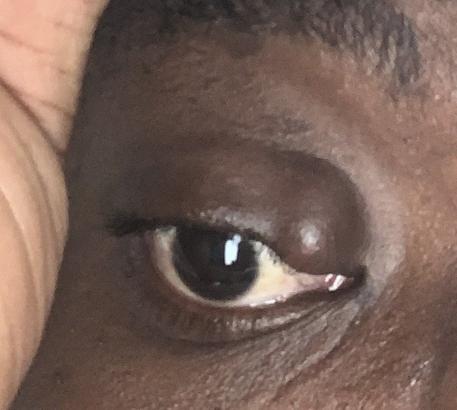 Stormblis's tweet photo. @HerbalistChief please any help with this chalazion https://t.co/PMq8jDB1JY