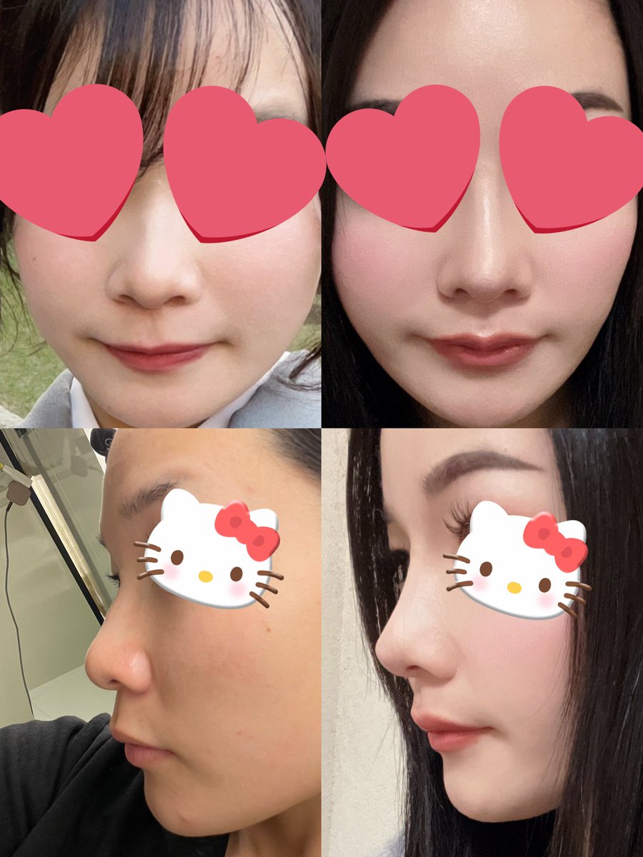 1Vilis_'s tweet photo. @prs_urban さんで目鼻フルしてから半年が経ちました👶🏻💕
目はイ・ジョンミン先生、鼻はチェ・ウンギュ先生に執刀していただきました✨️ https://t.co/KaasEt1hby