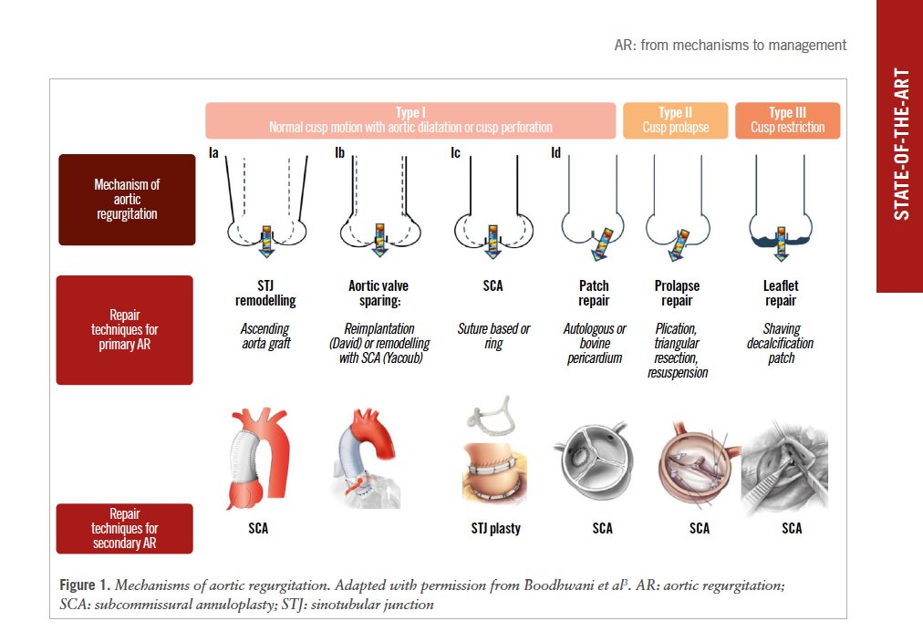 EuroInterventio's tweet photo. Aortic regurgitation: a common yet underrecognized condition. This review explored its mechanisms, diagnostic advances, and evolving therapies, including surgical and transcatheter options. Read more: https://t.co/vUjVKiJAqE   

#Cardiology #AorticRegurgitation #HeartCare https://t.co/j2AwLjsAsX