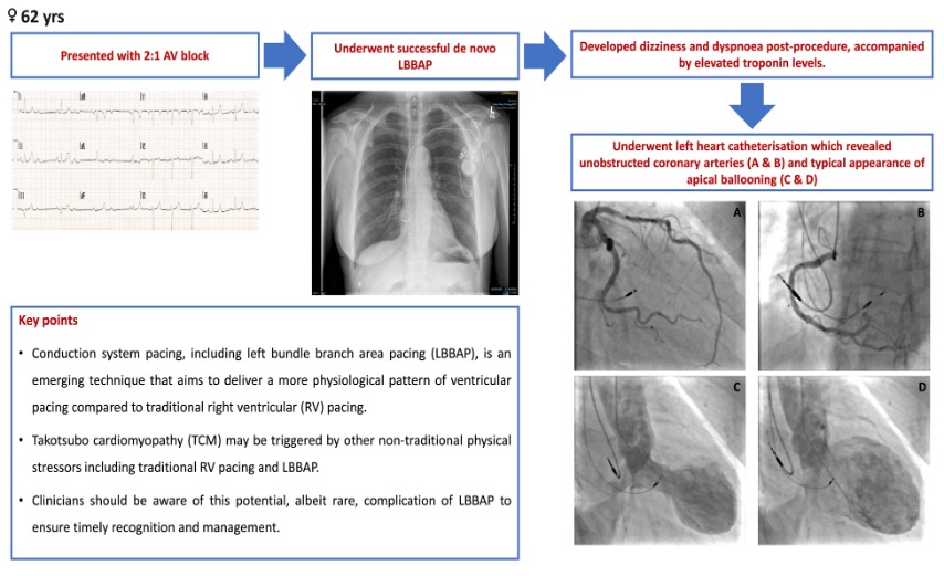 #Takotsubo syndrome induced by de novo left bundle branch area pacing: a case report bit.ly/4eyy5R4

#EHJCaseReports <a href="/Phiso_de/">Philipp Sommer</a> <a href="/TJ_Yeo/">Tee Joo YEO</a> <a href="/aayshacader/">Aaysha Cader</a> <a href="/BoldiKovacsMD/">Boldizsar Kovacs</a> <a href="/KardiologieHH/">Erik Rafflenbeul</a> <a href="/ANazmiCalik/">A.Nazmi Calik</a> <a href="/O_Azizy_MD/">Obayda Azizy</a> <a href="/saramoscatelli7/">Sara Moscatelli</a> <a href="/EHJCREiC/">EHJCaseReports Editor-in-Chief</a> #CardioX