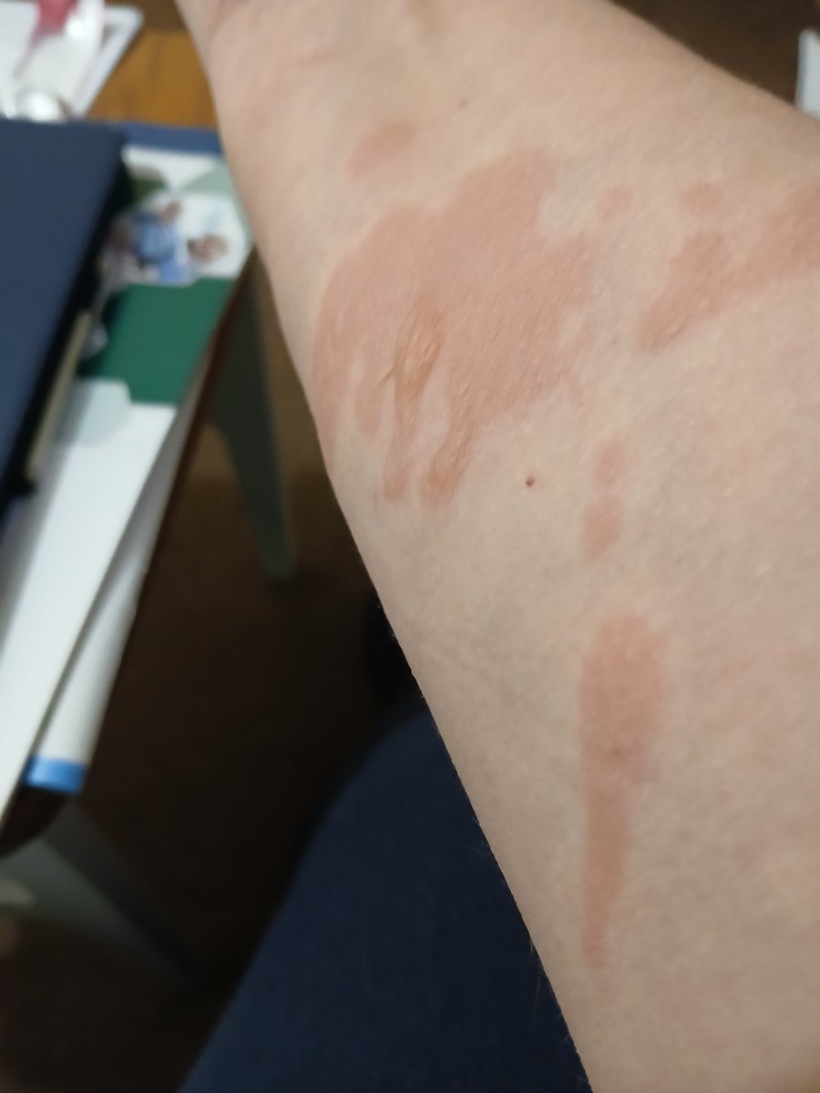 Cooked my sister's xmas dinner yesterday and had a fight with the hot cooking oil. Ouch!!