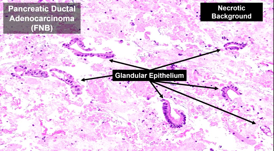 Janiranavarro's tweet image. Pancreas-core needle biopsy
Not infrequently you get beautiful core biopsies but the neoplastic cells are at the periphery of the cores, as "free floating" tissue
If you have SMAD4 IHC, it could help you with the diagnosis

Dr. Singhi #CAP24 #pathology #PathTwitter #PathX