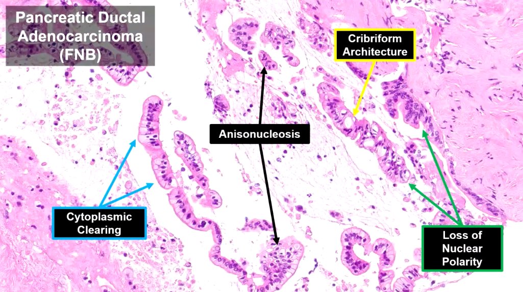 Janiranavarro's tweet image. Pancreas-core needle biopsy
Not infrequently you get beautiful core biopsies but the neoplastic cells are at the periphery of the cores, as "free floating" tissue
If you have SMAD4 IHC, it could help you with the diagnosis

Dr. Singhi #CAP24 #pathology #PathTwitter #PathX