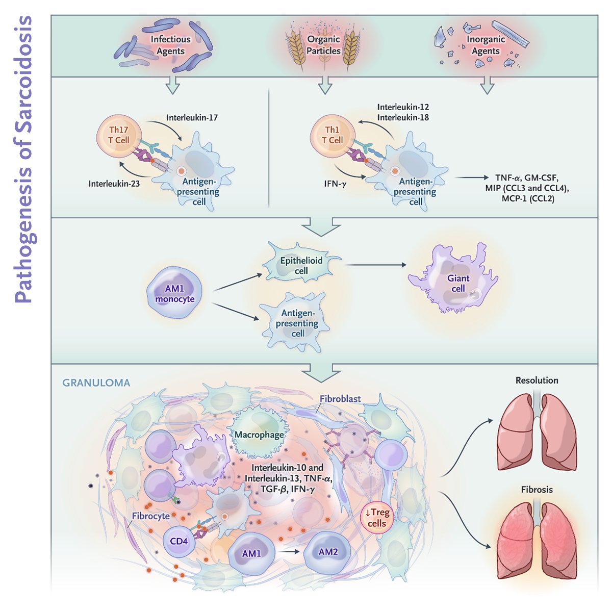 Sarcoidosis is a granulomatous disorder that affects people of all racial and ethnic backgrounds. The pathogenesis of sarcoidosis remains incompletely understood. Learn more in an Interactive Medical Case: nej.md/3UQ4s6V 

#MedEd