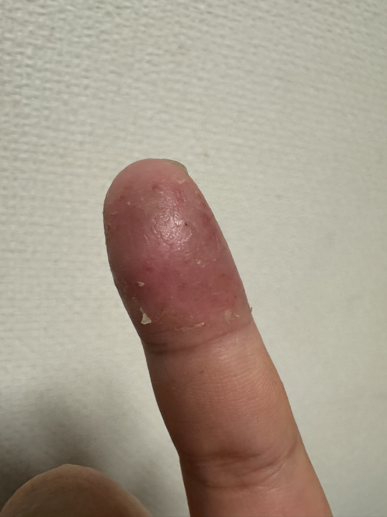 皮剥けた ゼオスキン~治療~ トレチノイン0.1% ver 経過レポ ◎ - きれいな