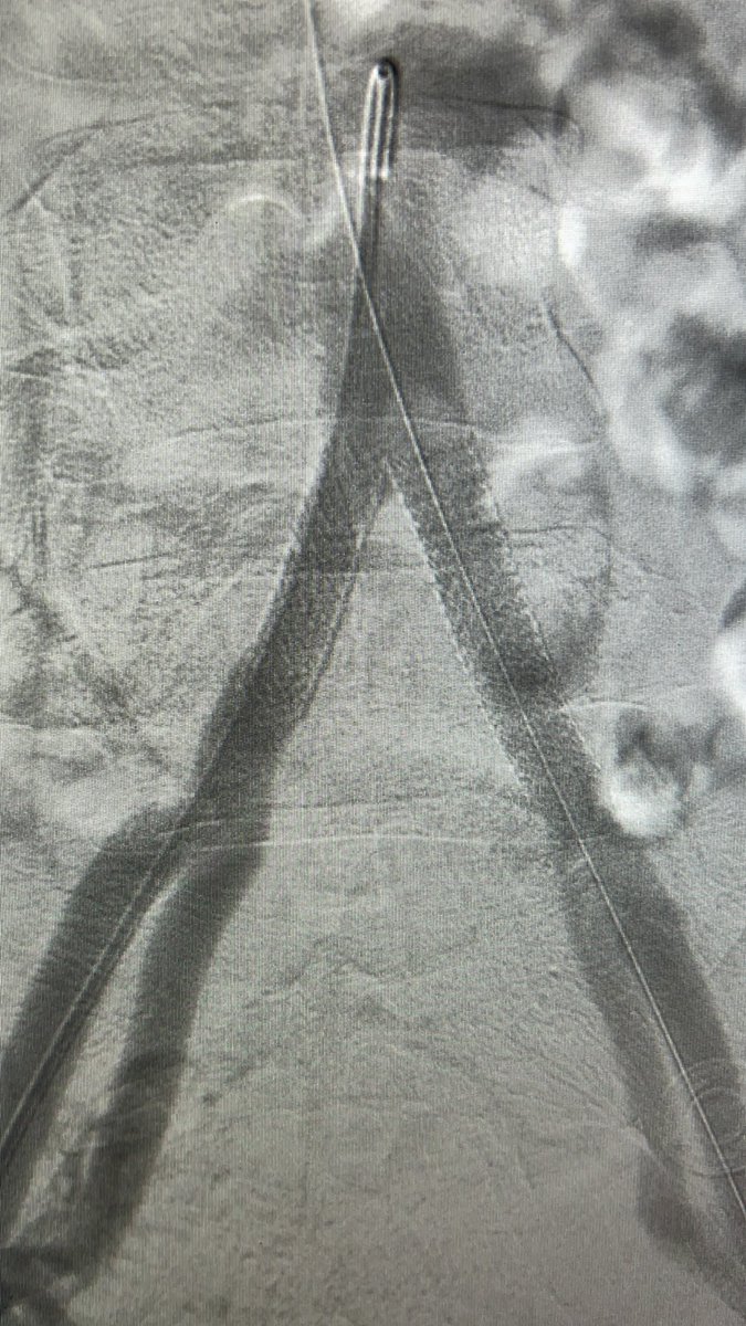 45y male CLI with CAD &amp; hx of CABG

POBA of rt SFA, retrograde crossing of lt CIA by balloon supported Command 0.018 gw, bilateral kissing bare metal BES

Restoration of pedal pulses 

#vascular <a href="/VascularForum/">Fórum Vascular</a> <a href="/CLI_Global/">CLI Global Society</a> #CLIFighter #endovascular