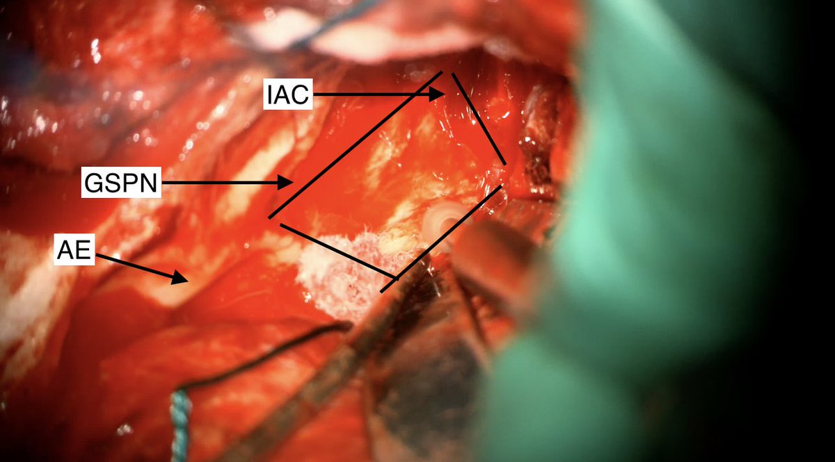 Gmaan Alzhrani MD, FRCSC. tweet media