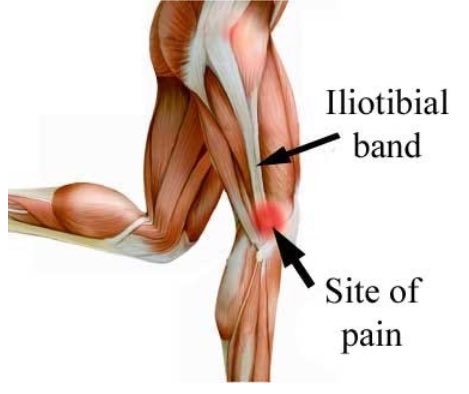 pt_rayed's tweet photo. متلازمة الشريط الحرقفي الظنبوبي (Iliotibial band syndrome ) يكون في الجهة الخارجية من الفخذ و غالباً الألم يتمركز في الركبة من الخارج.
هنا بعض التمارين اللي ممكن تساعدك في الألم 

#ألم #علاج_طبيعي #علاج #تأهيل #إصابة #رياضة #وجع #علاج #ركبة https://t.co/fT0hHVDDWa