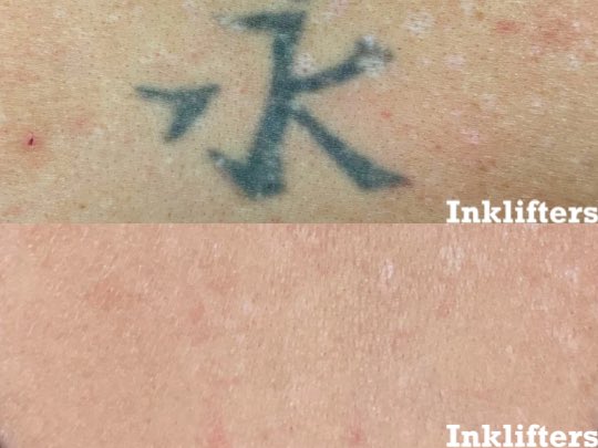 6 sessions later, and this tattoo is history 😎✌️ Our advanced tattoo removal treatments fade away unwanted ink, giving your skin a fresh new start- just in time for the New Year.