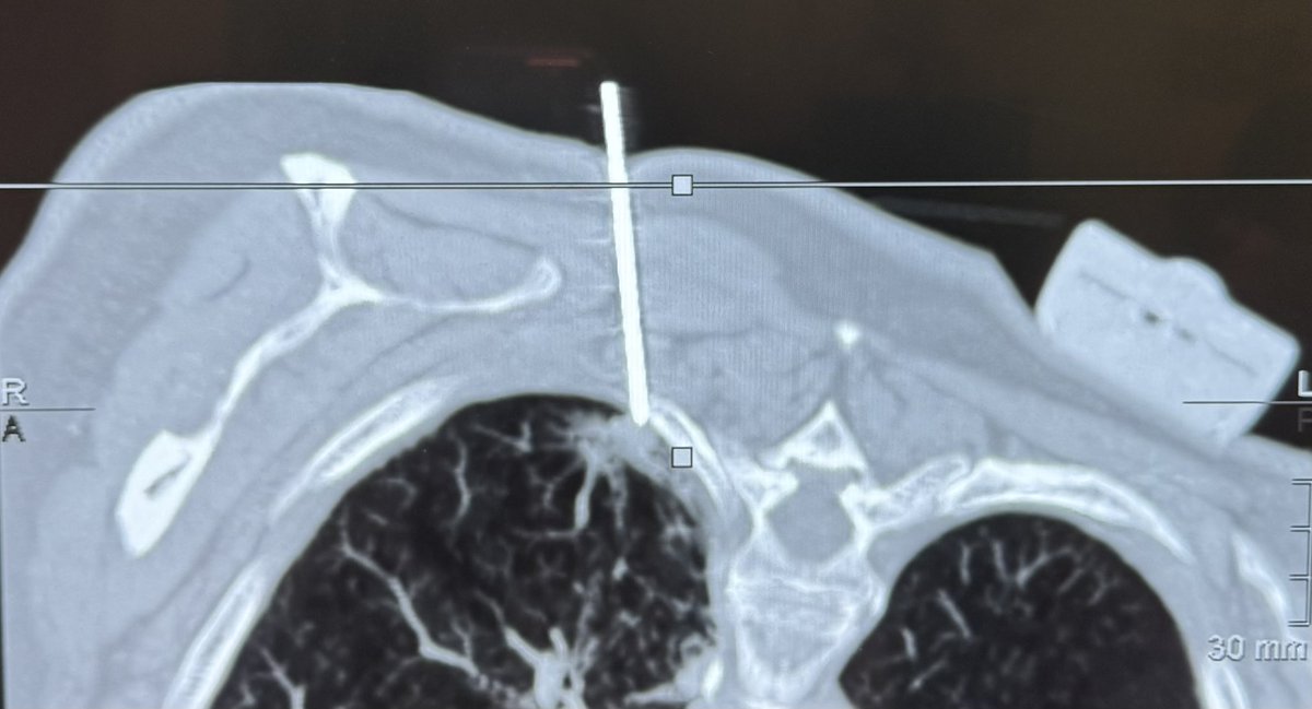 RADIOLOGIA CABUEÑES H.U. (@radiologiacahu) on Twitter photo La sección de Intervencionismo de nuestro servicio ha realizado varias biopsias guiadas por un sistema de navegación en TC. Permite disminuir el número de punciones y la dosis de radiación administrada al paciente. <a href="/CAHU_Area_V/">CAHU Área Sanitaria V</a> @GEHealthCare_ES <a href="/CtNavigation/">IMACTIS CT-Navigation</a> La sección de Intervencionismo de nuestro servicio ha realizado varias biopsias guiadas por un sistema de navegación en TC. Permite disminuir el número de punciones y la dosis de radiación administrada al paciente. <a href="/CAHU_Area_V/">CAHU Área Sanitaria V</a> @GEHealthCare_ES <a href="/CtNavigation/">IMACTIS CT-Navigation</a>