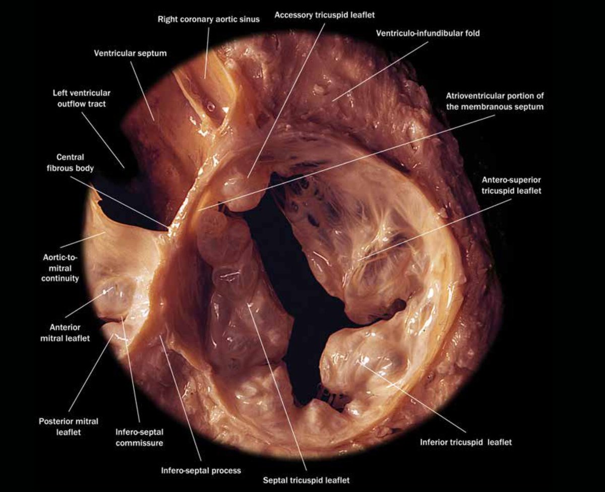 pzhong2016's tweet photo. tricuspid valve and ring https://t.co/DLeiGNz3x5