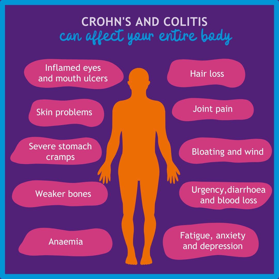 Almost 24,000 people are diagnosed with Crohn's or Colitis each year. That's about 66 people every day. These are just some of the symptoms they could experience​, showing how Crohn’s and Colitis can affect people in so many ways. 

Visit: crohnsandcolitis.org.uk

#IBD
