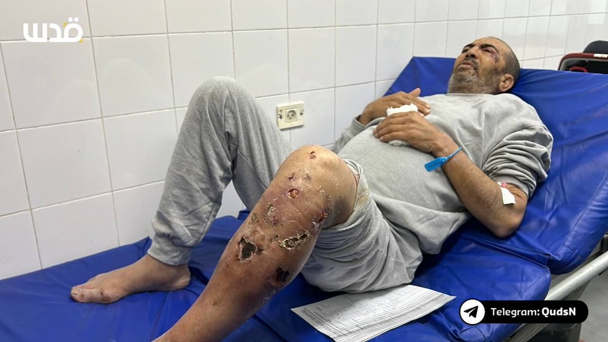 A released Palestinian prisoner shows symptoms of severe torture upon his release from Israeli prisons this morning.