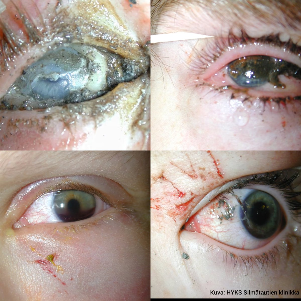 ☝️👨‍🚒 Nyt on hyvä hetki lukea professori Tero Kivelän <a href="/silmalaakarit/">Silmälääkäriyhdistys ry</a> tiedote viimevuoden ilotulitevammoista, jotka kaikki olisi voitu estää, jos niissä olisi noudatettu valmistajien ja viranomaisten ohjeita. 👇
silmalaakariyhdistys.fi/selvitykset/il…
#ilotulitteet #uusivuosi #silmävamma