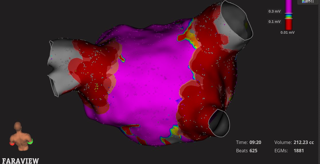 Mdmetzl's tweet image. First cases with Faraview @EndeavorHlth CVI were impressive. Great to visualize Farawave without pulling a mapping catheter. No suprise @BSCCardiology did a really nice job integrating these technologies! #Epeeps @JWasserlaufMD @doctorwes @jnazari @HanyDemo
