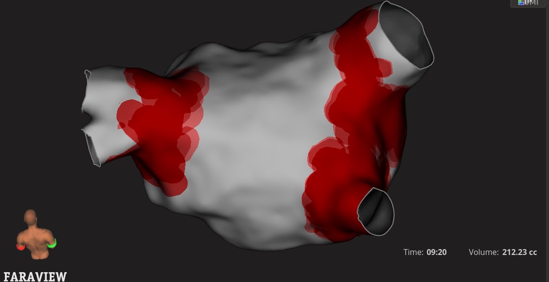Mdmetzl's tweet image. First cases with Faraview @EndeavorHlth CVI were impressive. Great to visualize Farawave without pulling a mapping catheter. No suprise @BSCCardiology did a really nice job integrating these technologies! #Epeeps @JWasserlaufMD @doctorwes @jnazari @HanyDemo