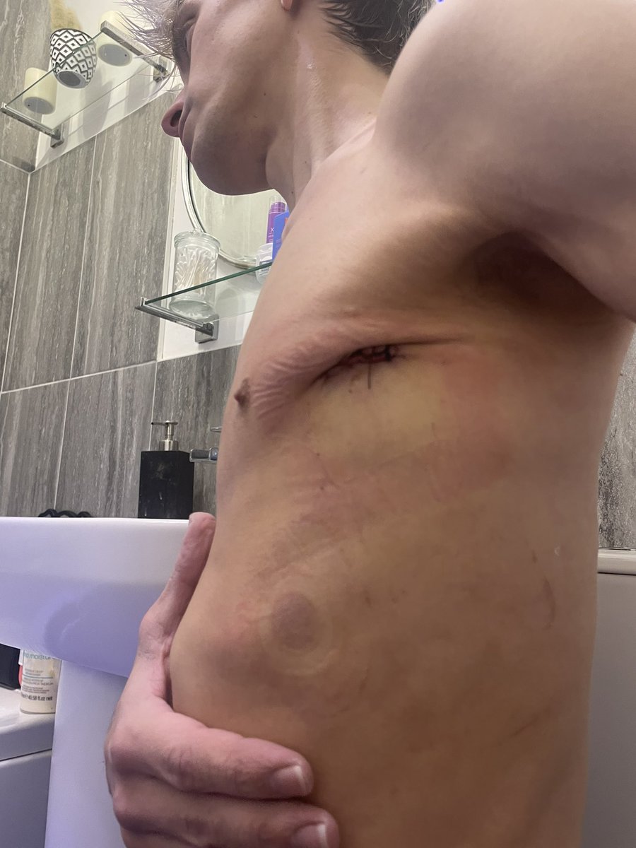 MatthewRobertsO's tweet photo. 4 lung collapses 
2 lung 🫁 operations 
Third operation on its way 
Someone send me fucking help before my anxiety takes me over the rainbow 🌈 🤢 
#pneumothorax #LungCollapse #SendHelp https://t.co/MPfFCbvF6V
