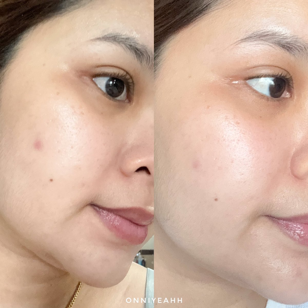 เดอะเบสมากกก Effaclar serum ของลา โรช-โพเซย์ สิวอุดตัน สิวหัวแดงๆไม่มีหัวเอาอยู่หมด ขวดเดียวเอาอยู่จริงเพราะมี LHA ช่วยผลัดรอยสิว, Salicylic acid สลายสิวอุดตัน ลดการสะสมแบคทีเรียในรูขุมขน ,Glycolic acid ไม่ให้เกิดสิวที่รุนแรง และมี Niacinamide ปลอบประโลมผิว ไม่ทำให้ผิวระคายเคือง อ่อนโยนต่อผิวด้วย👍🏻🩵

Effaclar Serum
🩵https://t.co/dzD0qnV7ck 
🩵https://t.co/ToeTLSzXdU 

#LaRochePosayTH #Effaclar #ลาโรชโพเซย์ #เอฟฟาคลาร์ #สลายสิว #เอฟฟาคลาร์เซรั่ม #EffaclarSerum #รอยสิว #สิวอุดตัน