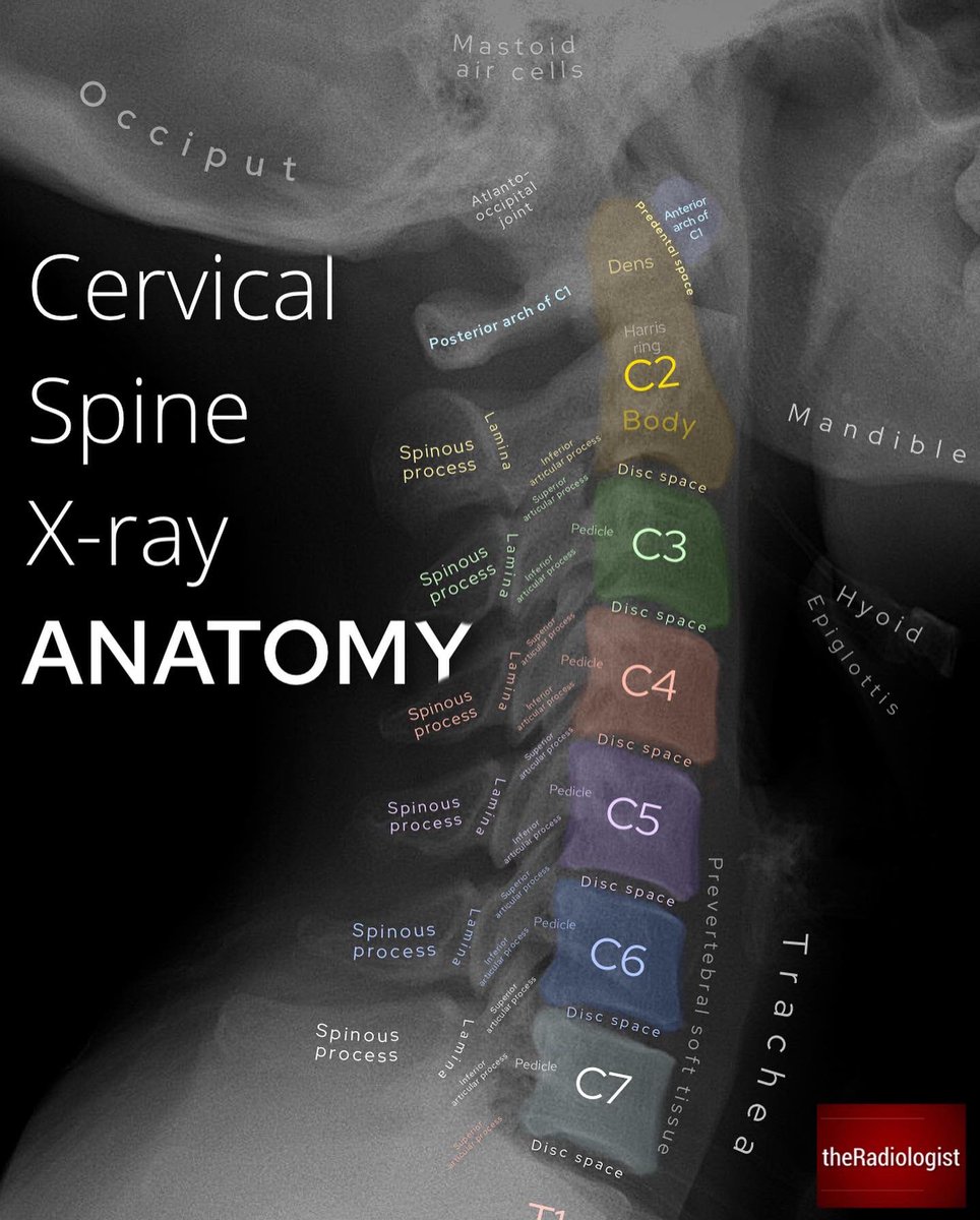 Although CT is now first line in many countries, X-Ray is still done in many places across the world to assess for C-spine injury in trauma 

Open the thread for a system on how to assess an adult lateral C-spine X-ray