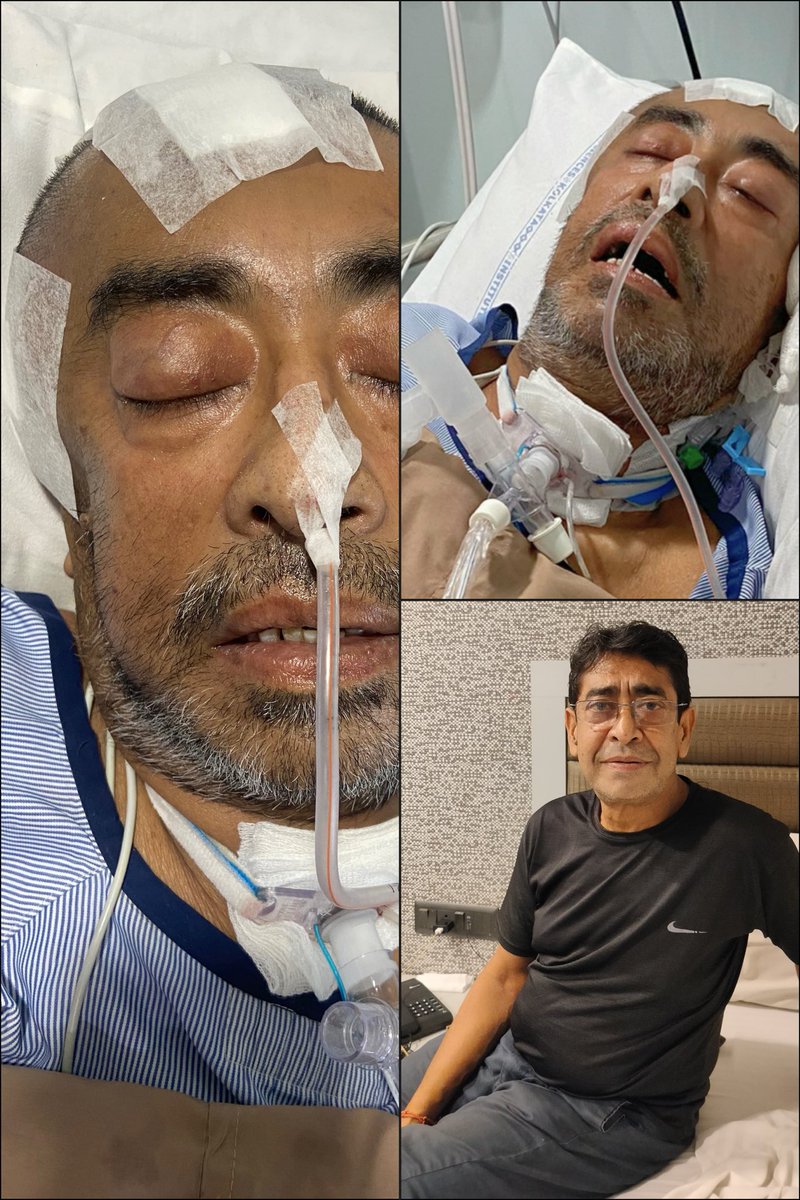 sommondal1994's tweet image. "URGENT🚨 After brain hemorrhage, my dad underwent open skull surgery. He's in coma &amp;amp; 3-4 months of treatment req. I've spend ₹15Lacs, but still require 30 Lac, daily cost 50k-1Lac. Please SUPPORT🙏🏻impactguru.com/fundraiser/hel… #MedicalEmergency #Crowdfunding #HopeForRecovery #Support